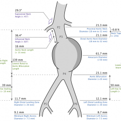 Detailed procedural planning report generated by EndoSize.