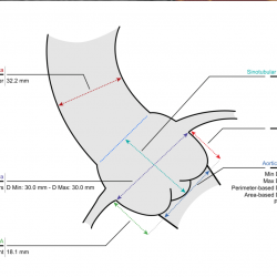 Detailed interventional planning report generated by EndoSize.